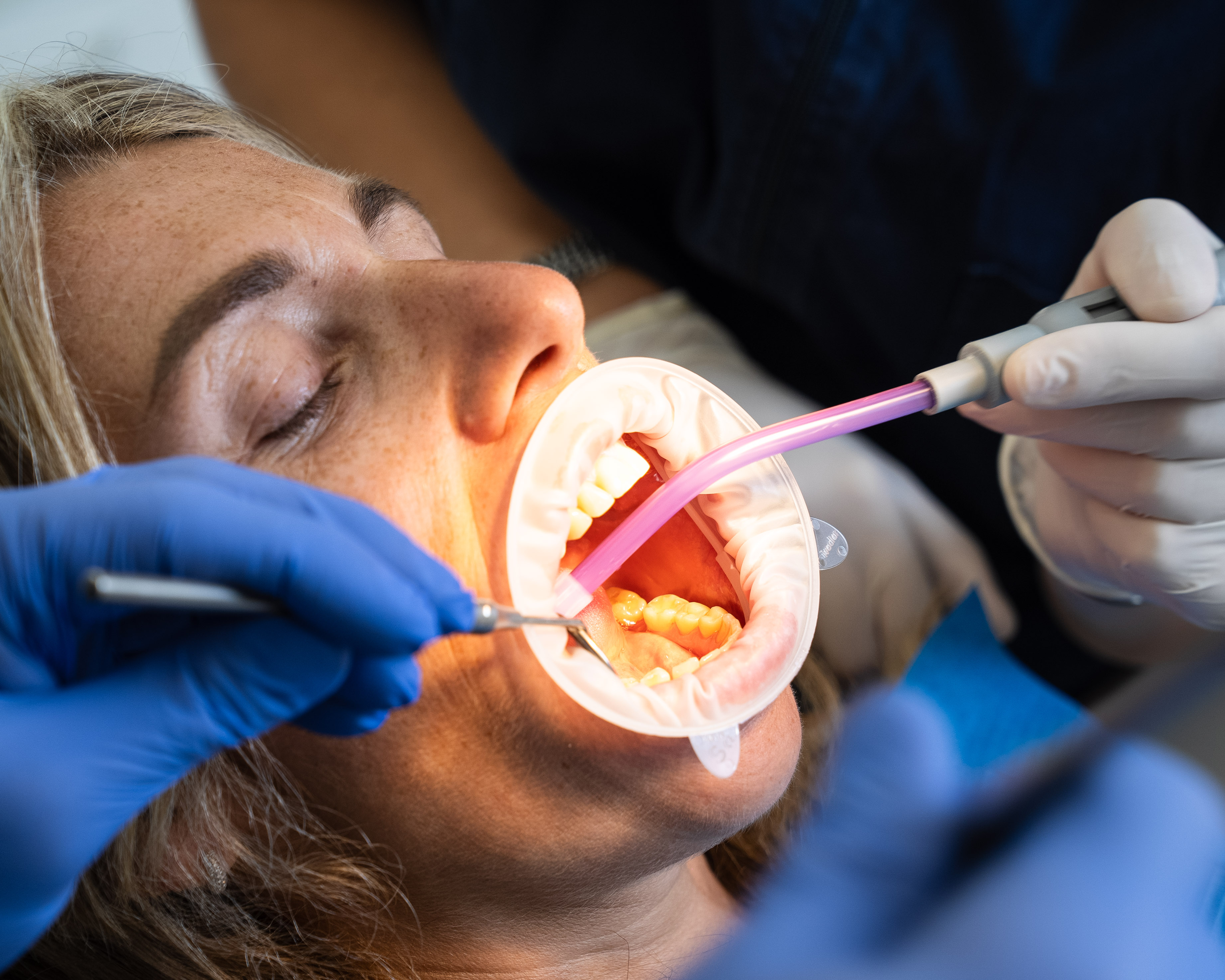 Dettaglio ablatori dentali